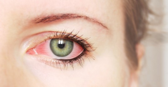 Ojos rojos: ¿Será conjuntivitis?