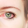 Ojos rojos: ¿Será conjuntivitis?